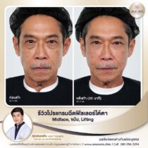 รีวิว ฉีดฟิลเลอร์ หมอต้น