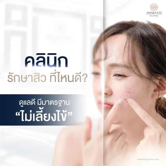 คลินิกรักษาสิวที่ไหนดี?