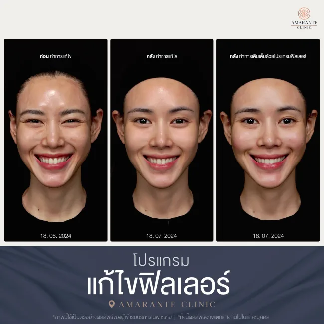 รีวิวแก้ไขฟิลเลอร์ที่ Amarante clinic