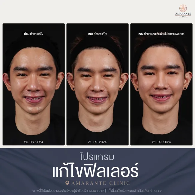 แก้ไขฟิลเลอร์ที่ Amarante clinic คุณกิม