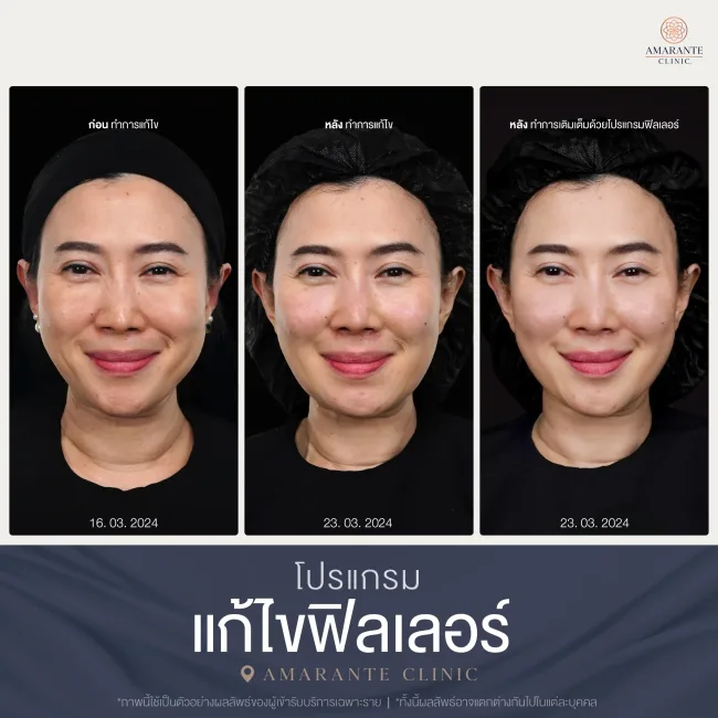 แก้ไขฟิลเลอร์ที่ Amarante clinic คุณแนน