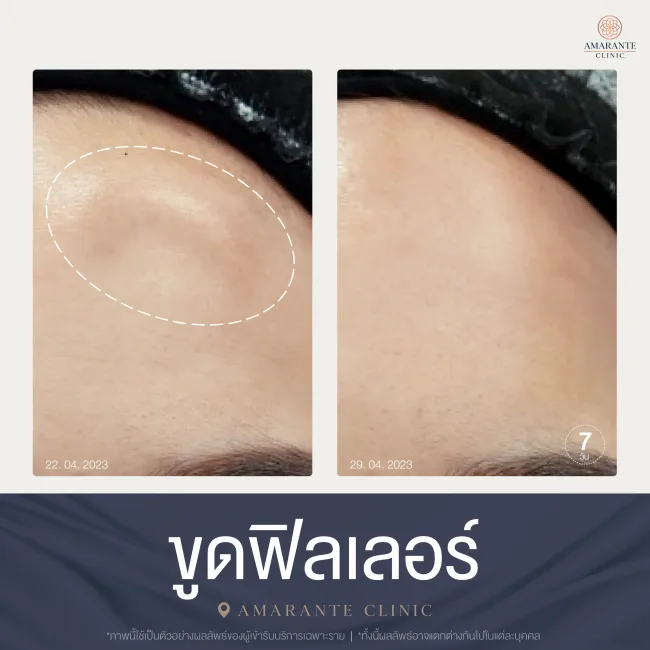 ขูดฟิลเลอร์ที่ Amarante clinic หน้าผาก