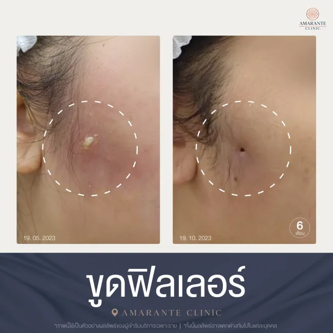 ขูดฟิลเลอร์ที่ Amarante clinic แก้ม