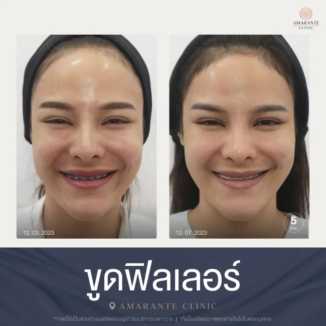ขูดฟิลเลอร์ที่ Amarante clinic ทั่วหน้า