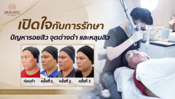 รักษาฝ้า กระ รอยดำ รอยแดงจากสิว หลุมสิว ด้วย Picosure Laser