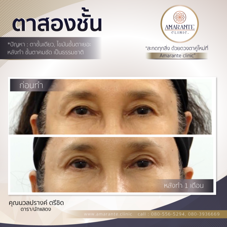 Template-ตาสองชั้น.