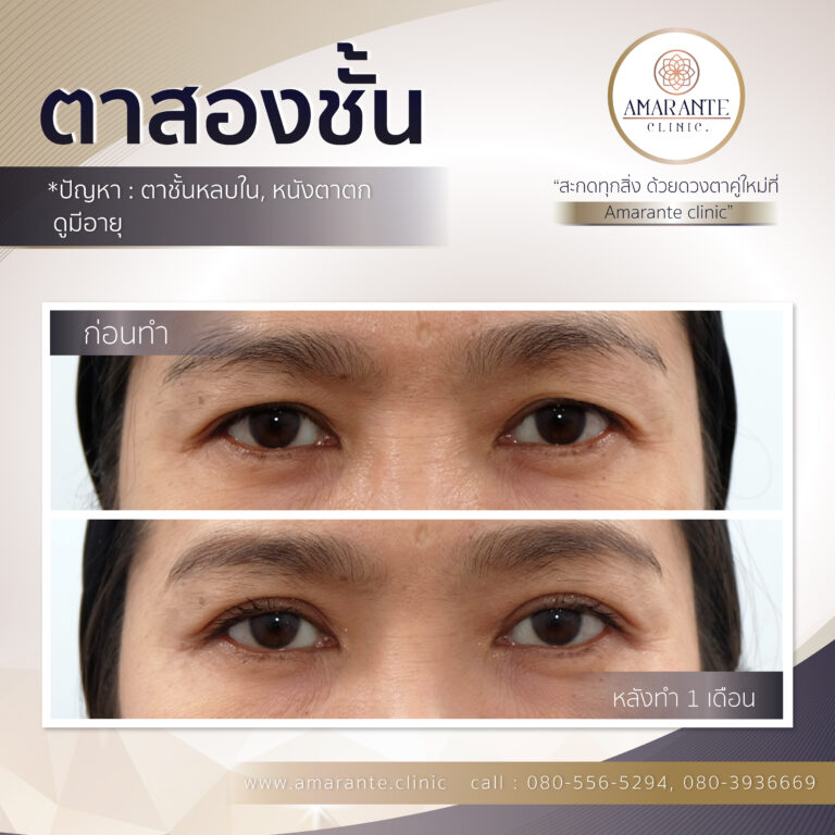 ตาสองชั้น, ทำตาสองชั้น, ศัลยกรรมตาสองชั้น (1)