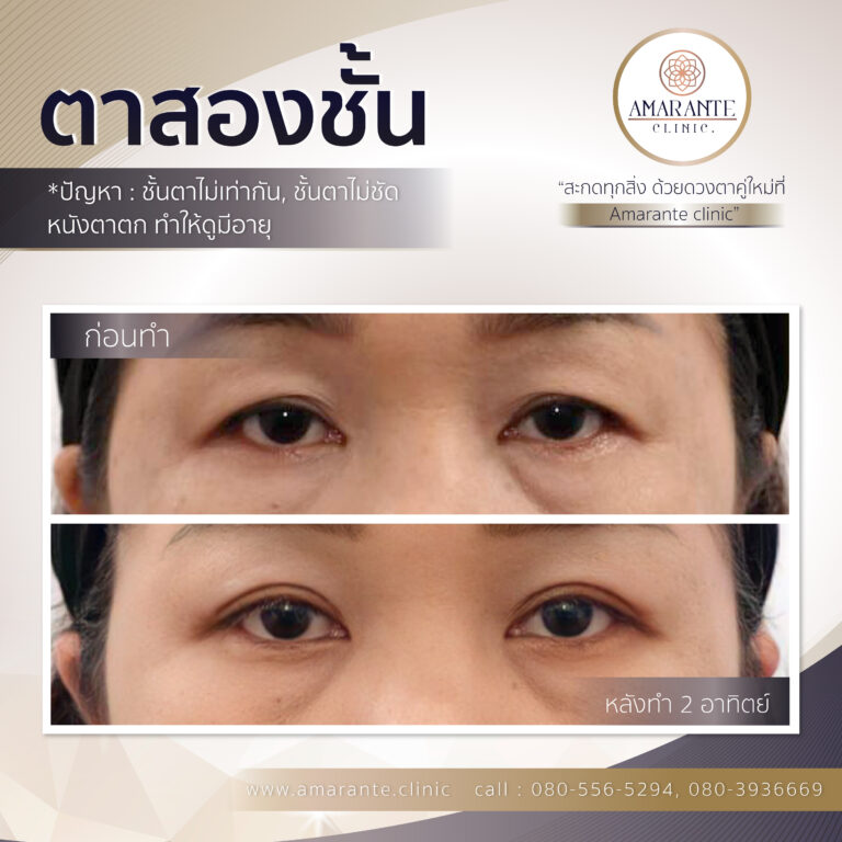 ตาสองชั้น, ทำตาสองชั้น, ศัลยกรรมตาสองชั้น (2)