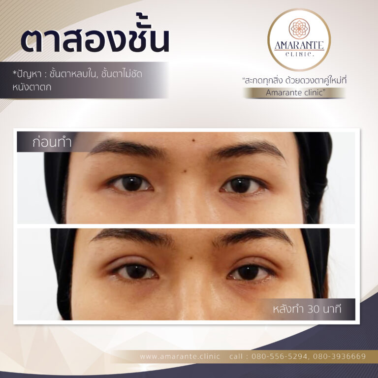 ตาสองชั้น, ทำตาสองชั้น, ศัลยกรรมตาสองชั้น (3)