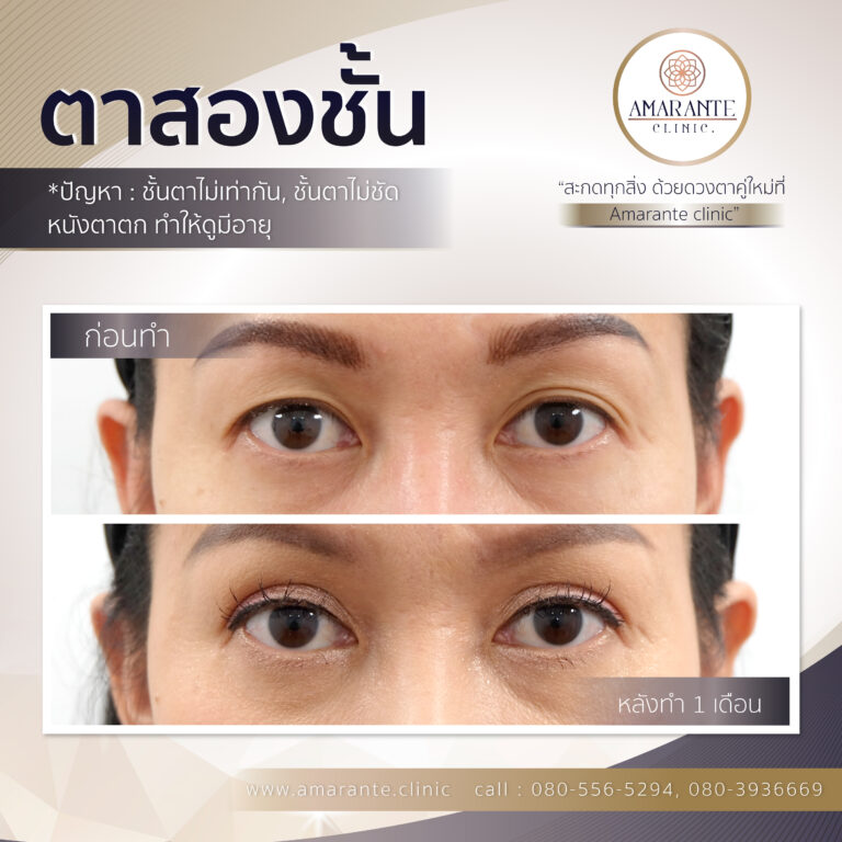 ตาสองชั้น, ทำตาสองชั้น, ศัลยกรรมตาสองชั้น (3)