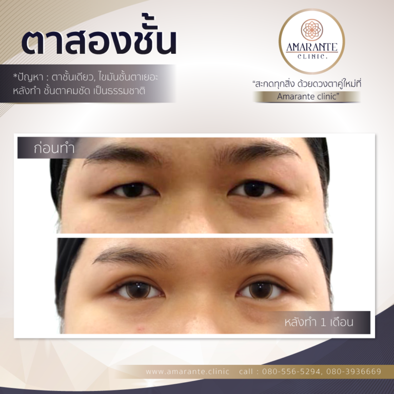 ตาสองชั้น, ทำตาสองชั้น, ศัลยกรรมตาสองชั้น (3)