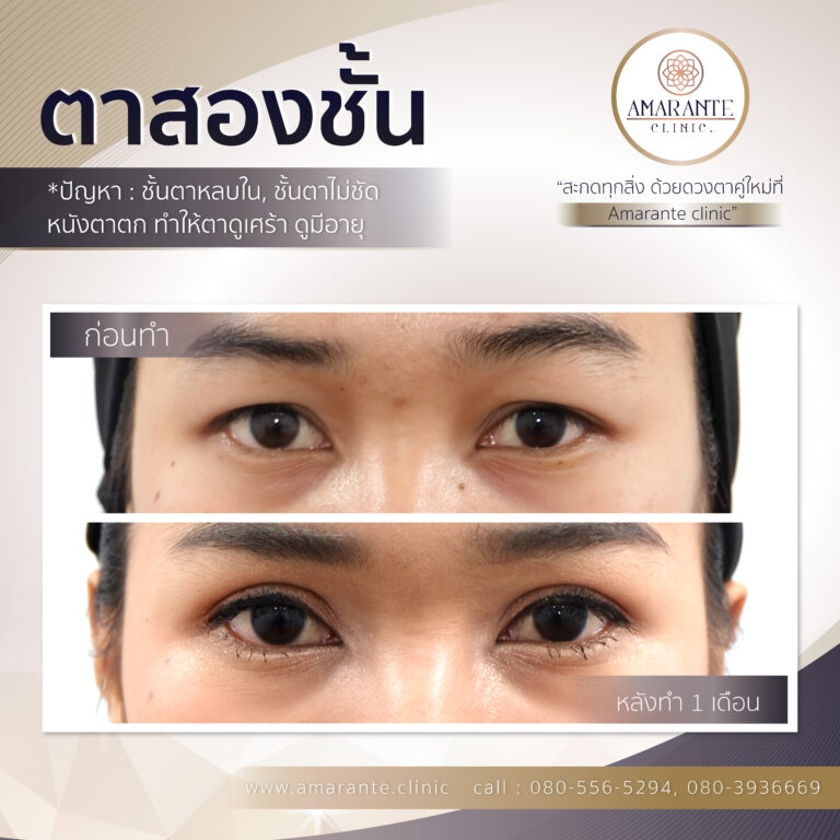 ตาสองชั้น, ทำตาสองชั้น, ศัลยกรรมตาสองชั้น (4)