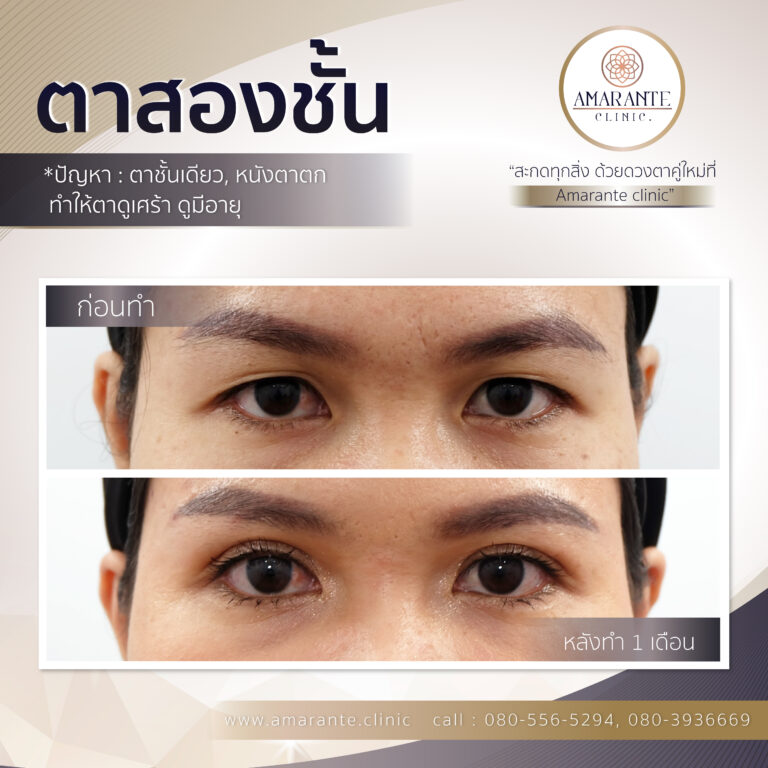 ตาสองชั้น, ทำตาสองชั้น, ศัลยกรรมตาสองชั้น (5)
