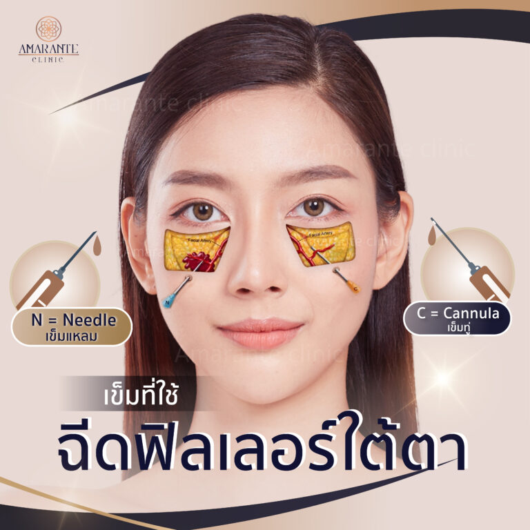 เข็มที่ใช้ในการฉีดฟิลเลอร์ใต้ตา