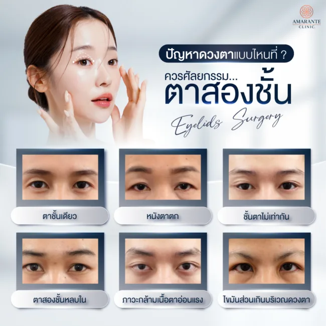 ปัญหาตาแบบไหนที่ควรศัลยกรรมตาสองชั้น