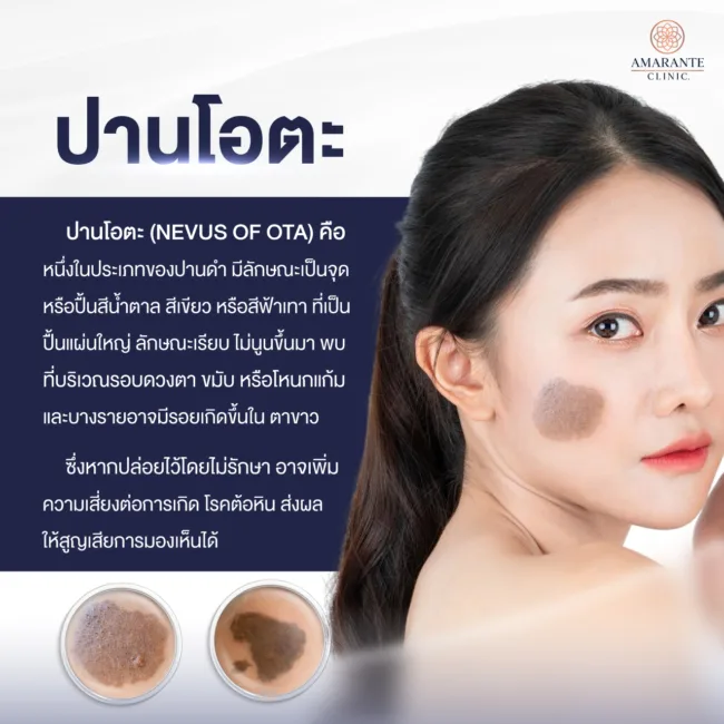 ปานโอตะ คืออะไร เกิดขึ้นได้อย่างไร