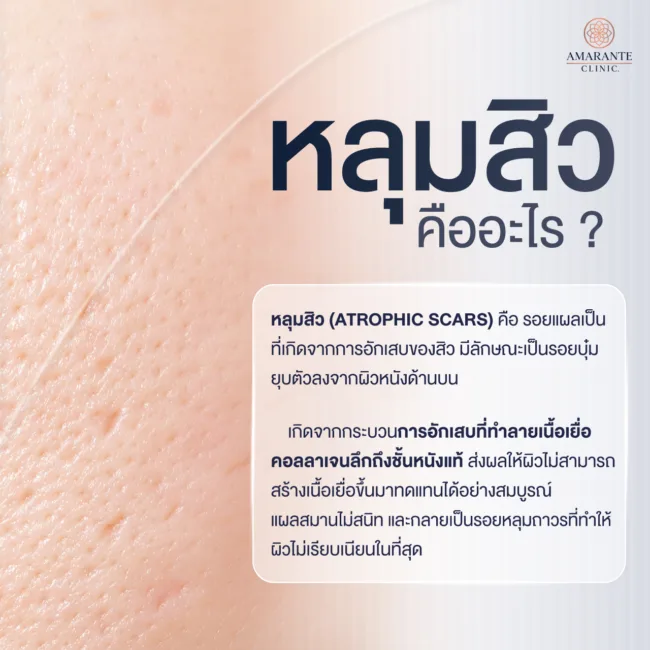 หลุมสิวคืออะไร