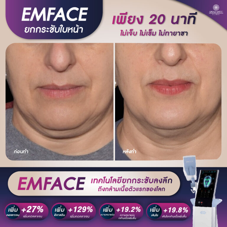 Emface รีวิว