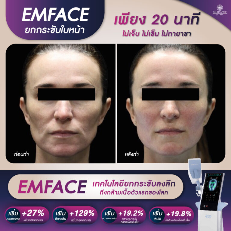 Emface รีวิว