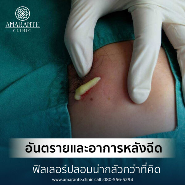 อาการหลังฉีดฟิลเลอร์ปลอม