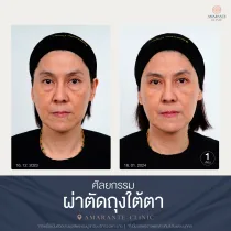 รีวิว ศัลยกรรม ผ่าตัดถุงใต้ตา