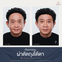 รีวิว ศัลยกรรม ผ่าตัดถุงใต้ตา