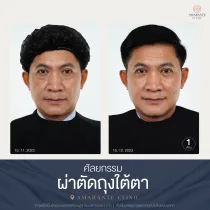 รีวิว ศัลยกรรม ผ่าตัดถุงใต้ตา