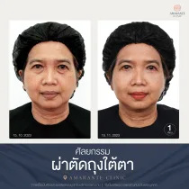 รีวิว ศัลยกรรม ผ่าตัดถุงใต้ตา