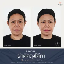 รีวิว ศัลยกรรม ผ่าตัดถุงใต้ตา