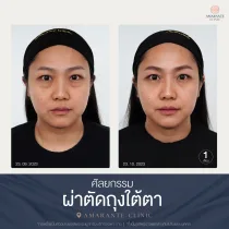 รีวิว ศัลยกรรม ผ่าตัดถุงใต้ตา