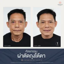 รีวิว ศัลยกรรม ผ่าตัดถุงใต้ตา