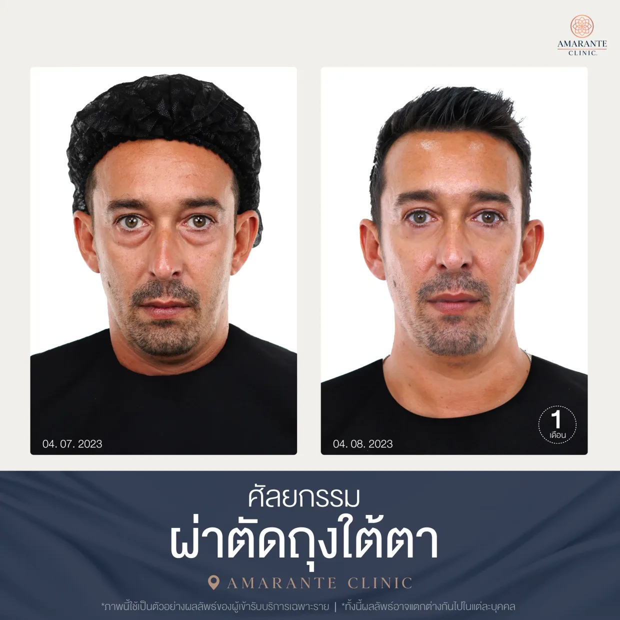 รีวิว ศัลยกรรม ผ่าตัดถุงใต้ตา