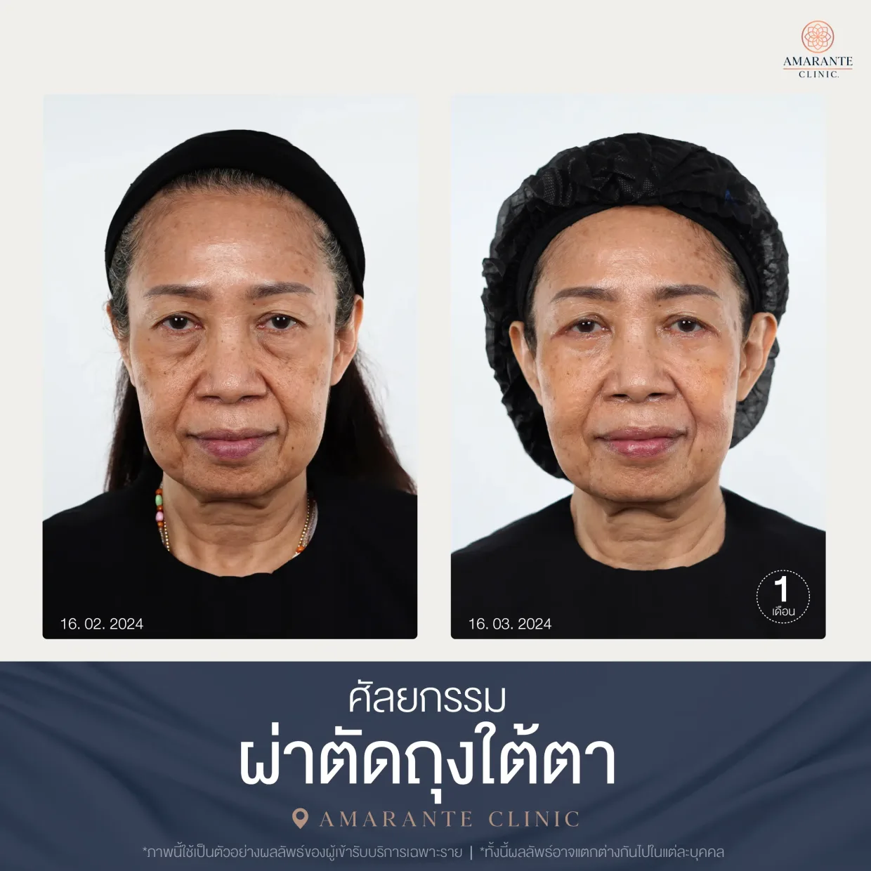 รีวิว ศัลยกรรม ผ่าตัดถุงใต้ตา