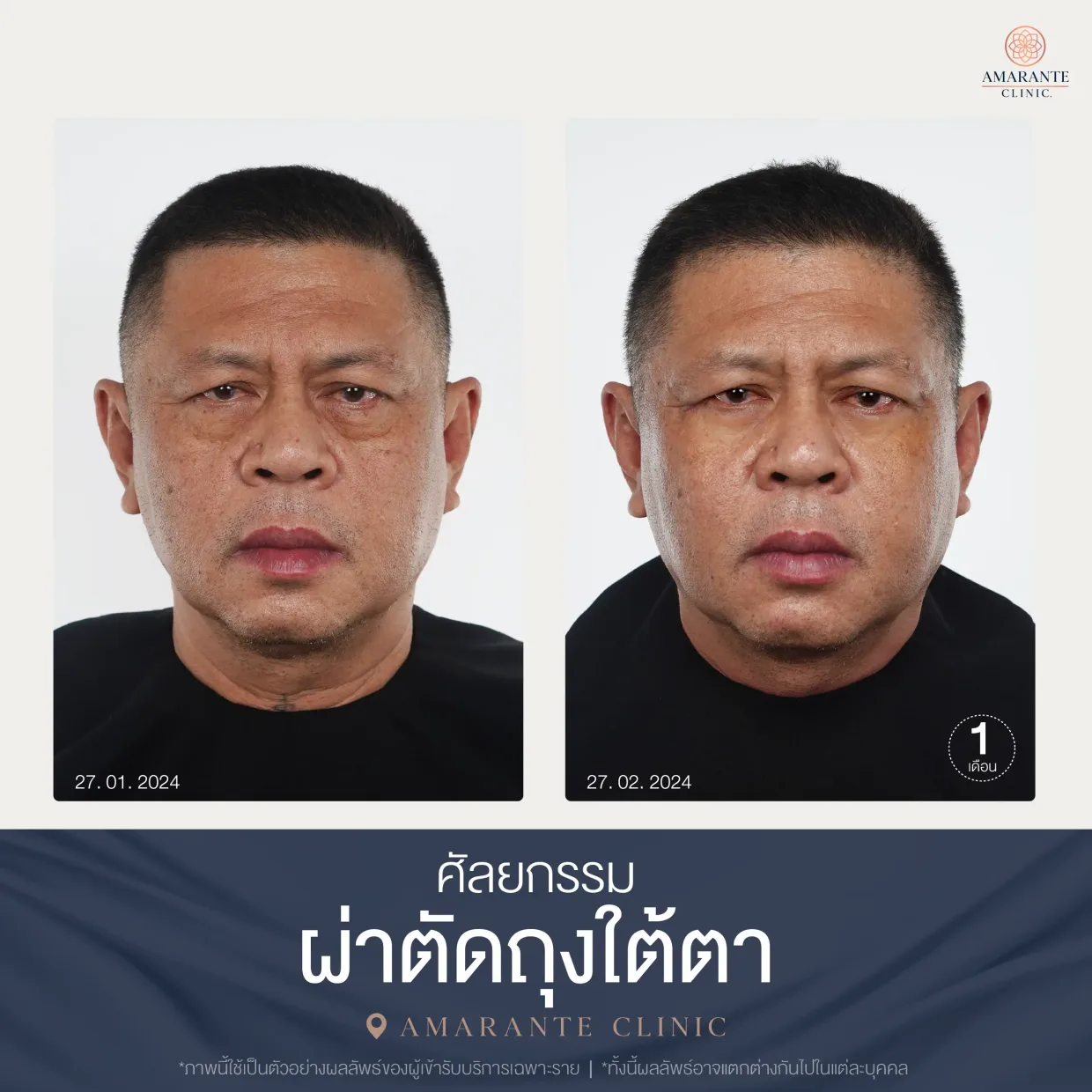 รีวิว ศัลยกรรม ผ่าตัดถุงใต้ตา