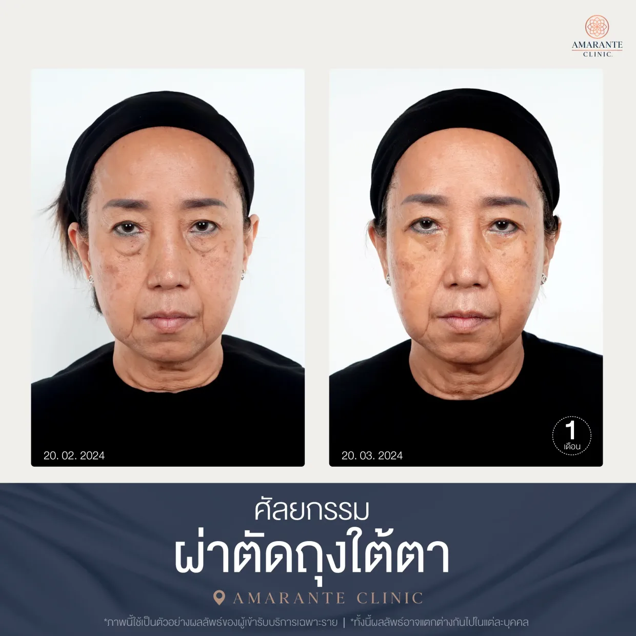 รีวิว ศัลยกรรม ผ่าตัดถุงใต้ตา