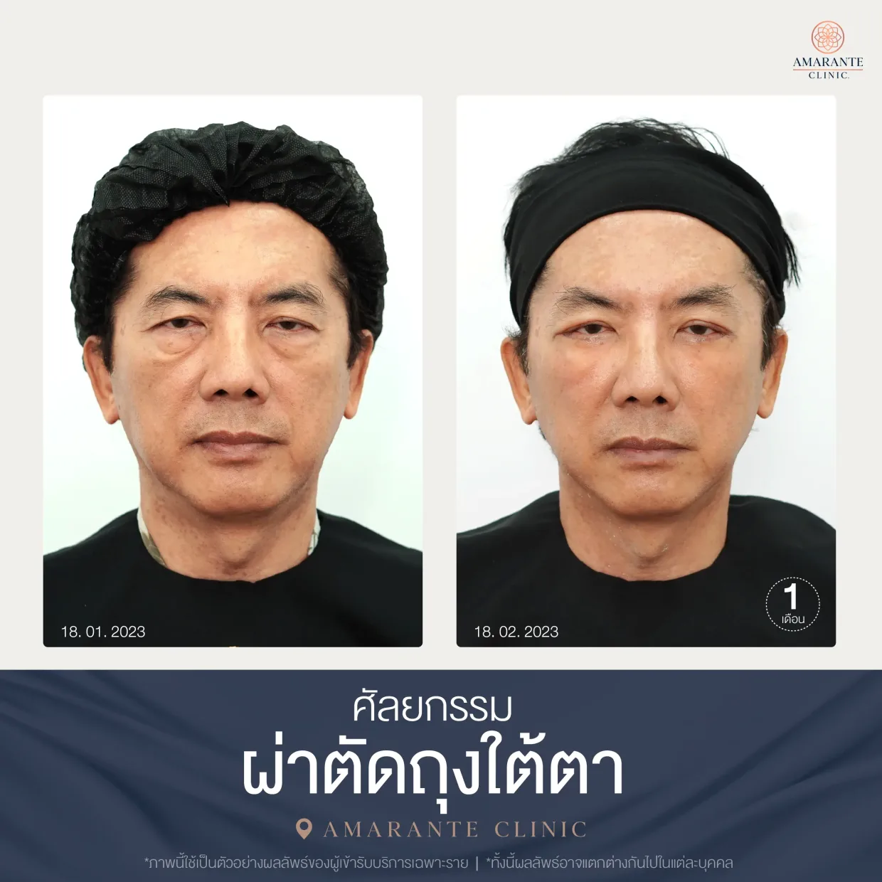 รีวิว ศัลยกรรม ผ่าตัดถุงใต้ตา