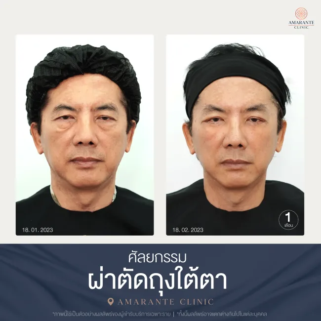 รีวิว ศัลยกรรม ผ่าตัดถุงใต้ตา