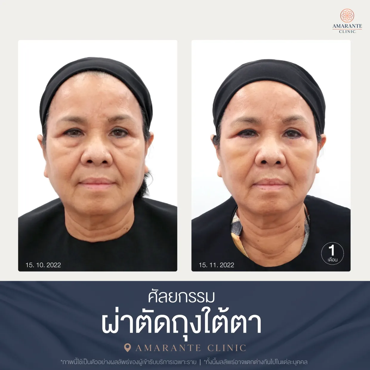 รีวิว ศัลยกรรม ผ่าตัดถุงใต้ตา