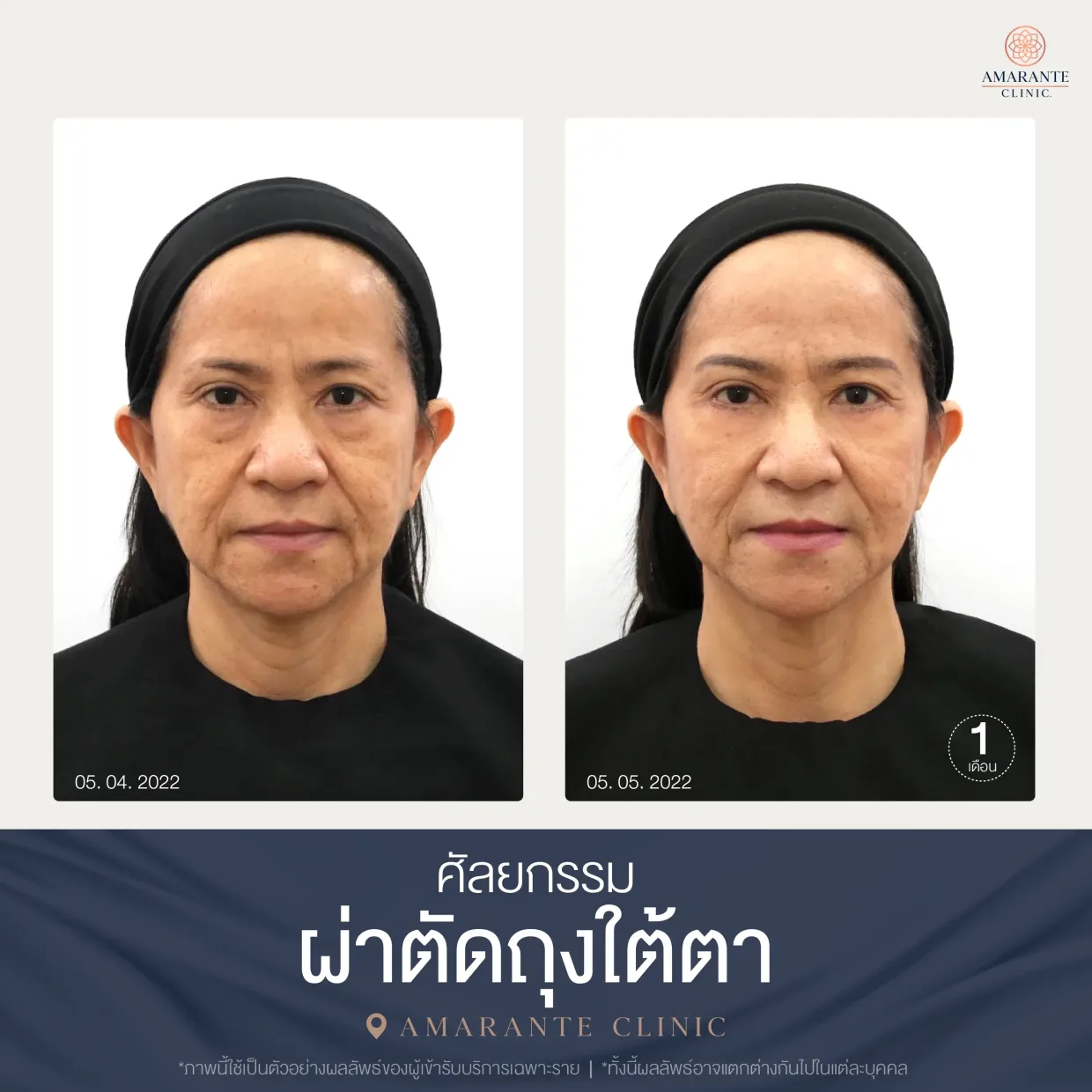 รีวิว ศัลยกรรม ผ่าตัดถุงใต้ตา