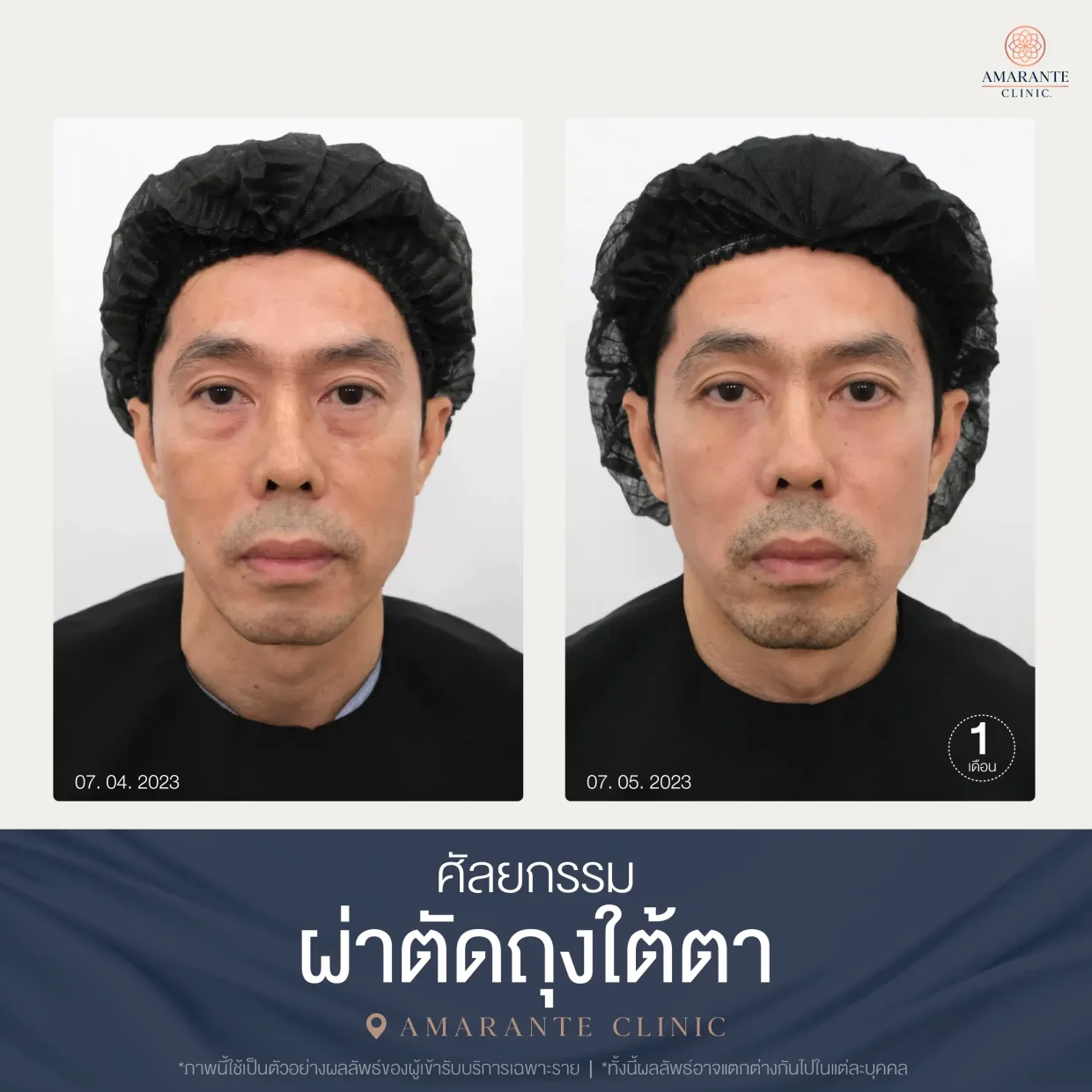 รีวิว ศัลยกรรม ผ่าตัดถุงใต้ตา