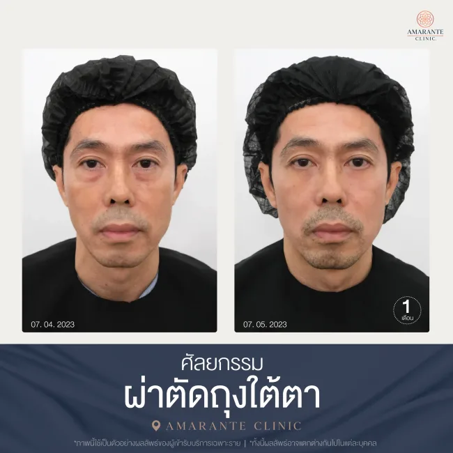 รีวิว ศัลยกรรม ผ่าตัดถุงใต้ตา
