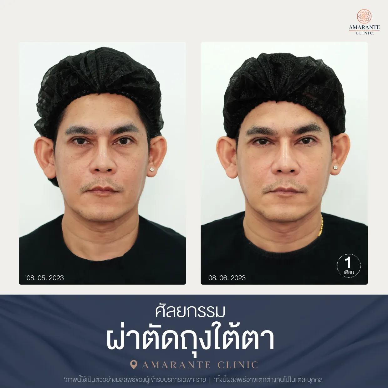 รีวิว ศัลยกรรม ผ่าตัดถุงใต้ตา