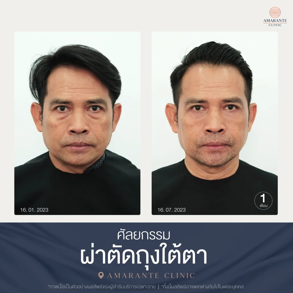 รีวิว ศัลยกรรม ผ่าตัดถุงใต้ตา