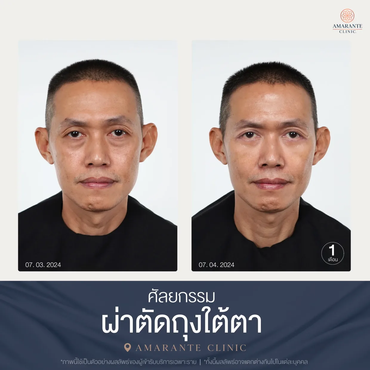 รีวิว ศัลยกรรม ผ่าตัดถุงใต้ตา