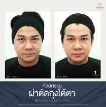 รีวิว ศัลยกรรม ผ่าตัดถุงใต้ตา