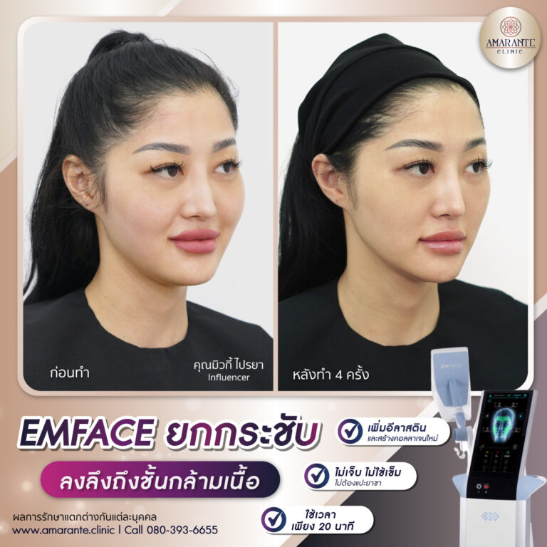 รีวิว Emface