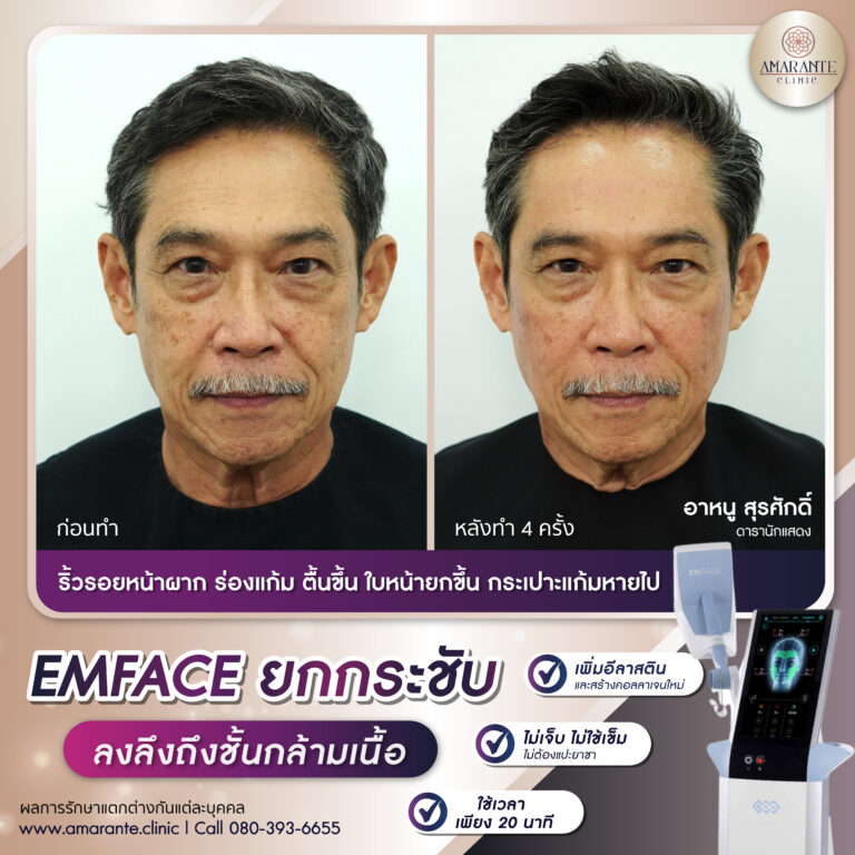รีวิว Emface