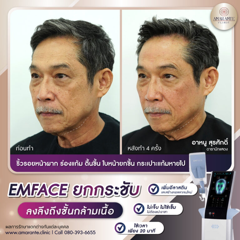 รีวิว Emface