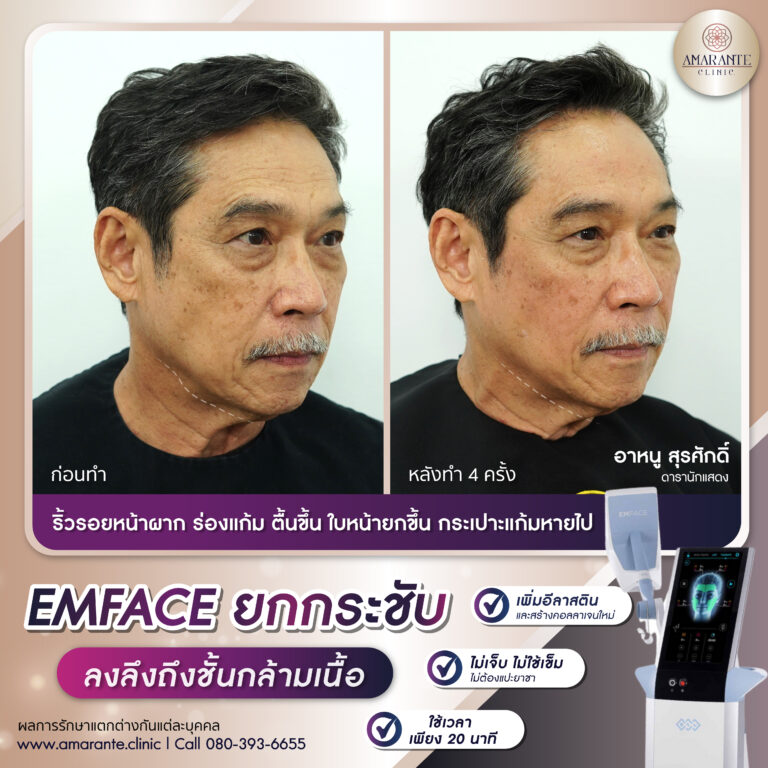 รีวิว Emface
