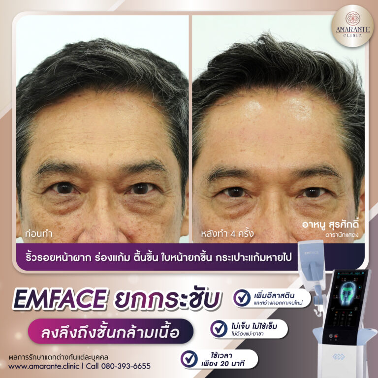 รีวิว Emface